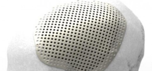 Renishaw CMF implant