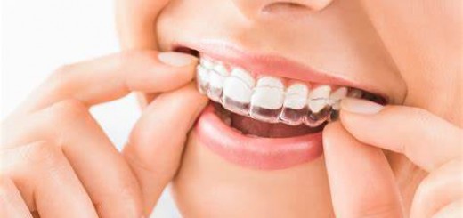 aligner